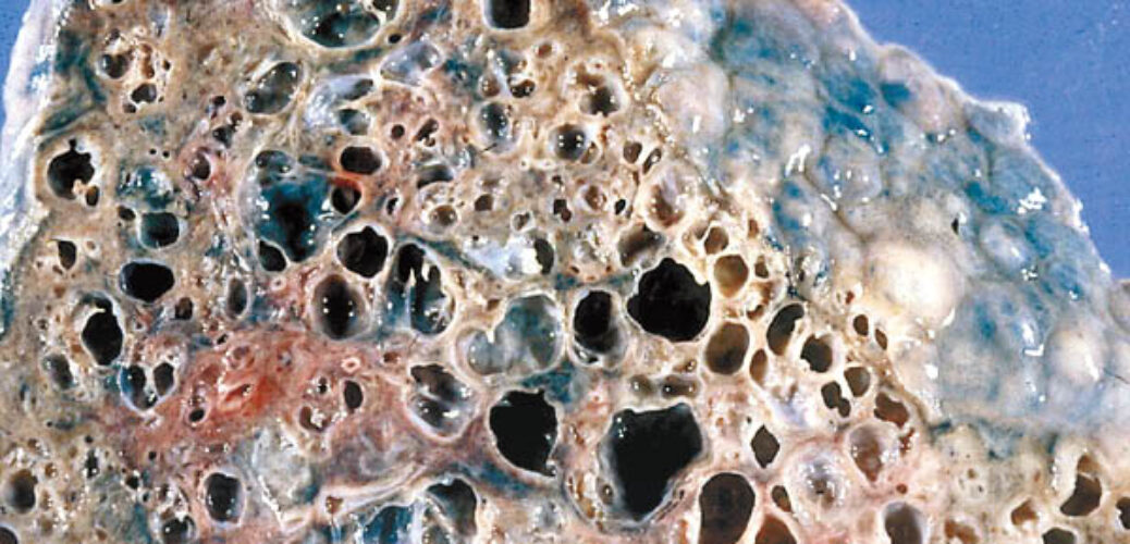 20200121_醫健：特發肺纖維化較癌更可怕